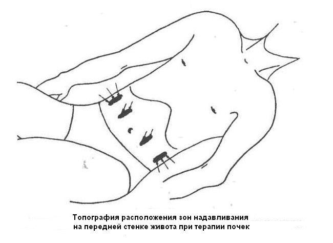 Как Вправить Пуп На Место